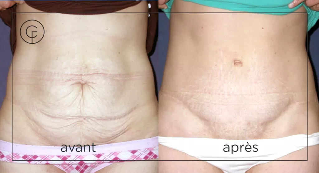avant-apres abdominoplastie
